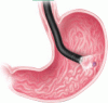 Managing acute upper GI bleeding, preventing recurrences