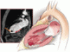 Left ventricular thrombosis can still complicate acute myocardial infarction