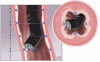 Current management of Barrett esophagus and esophageal adenocarcinoma