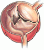 Aortic dissection: Prompt diagnosis and emergency treatment are critical