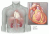 When should pharmacologic therapies be used for uremic pericarditis?