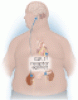 The role of GLP-1 receptor agonists in managing type 2 diabetes