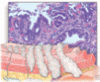 Esophageal adenocarcinoma: A dire need for early detection and treatment
