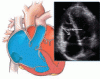 A young man with an unusual cause of palpitations