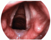 Laryngopharyngeal reflux: More questions than answers