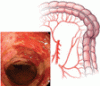 Clinical approach to colonic ischemia