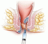 Hemorrhoids: A range of treatments