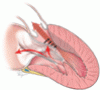 Hypertrophic cardiomyopathy: A complex disease