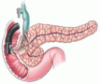 Endoscopic therapy of recurrent acute pancreatitis