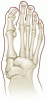 Charcot neuroarthropathy: An often overlooked complication of diabetes