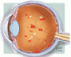 Diabetic retinopathy: Screening, prevention, and treatment
