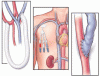Managing advanced chronic kidney disease: A primary care guide