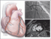 Myocardial infarction with nonobstructive coronary arteries: Current management strategies