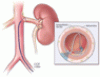 Should my patients with hypertension be referred for renal denervation?
