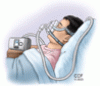 Treatments for obstructive sleep apnea: CPAP and beyond