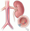 Procedures and devices to treat resistant hypertension in chronic kidney disease