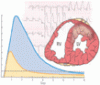 A new, precise definition of acute myocardial infarction