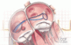 Risk-factor modification to prevent recurrent atrial fibrillation after catheter ablation